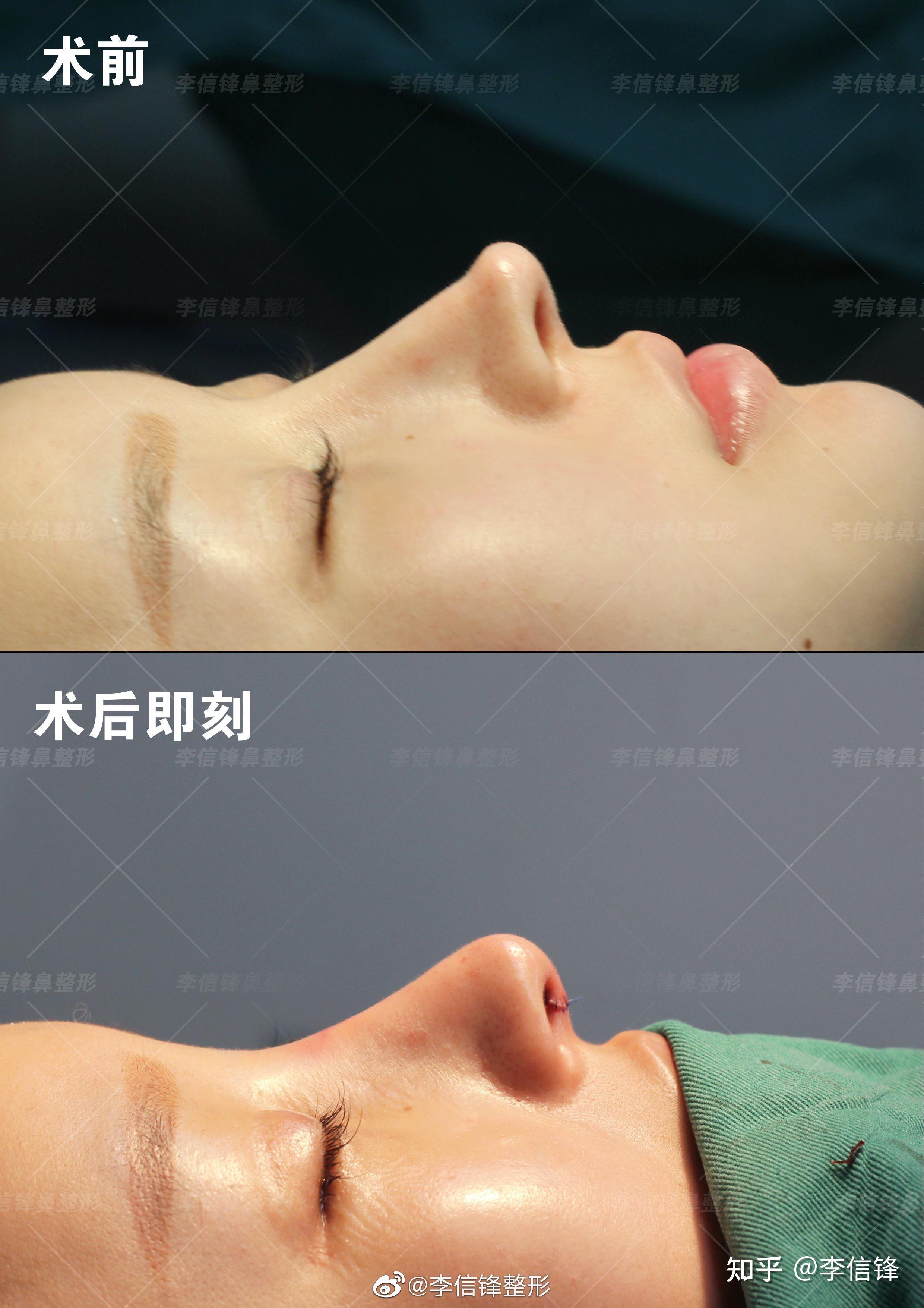 鼻小叶调整,鼻孔调整,筋膜加厚皮肤等;术后对比~【网红鼻修复案例】该