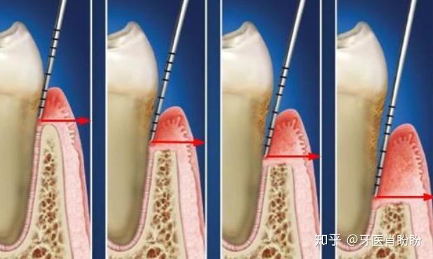 2,形成牙周炎,導致牙周附著喪失,隨著齦溝的加深會形成真性牙周袋.