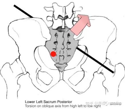 骶髂关节错位症状图片