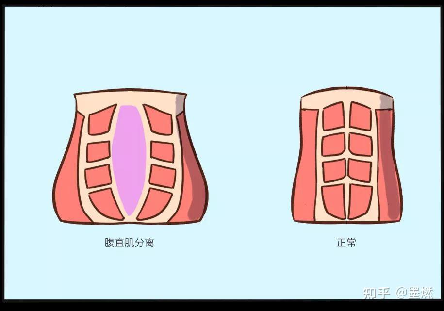 产后腰痛——腹直肌分离