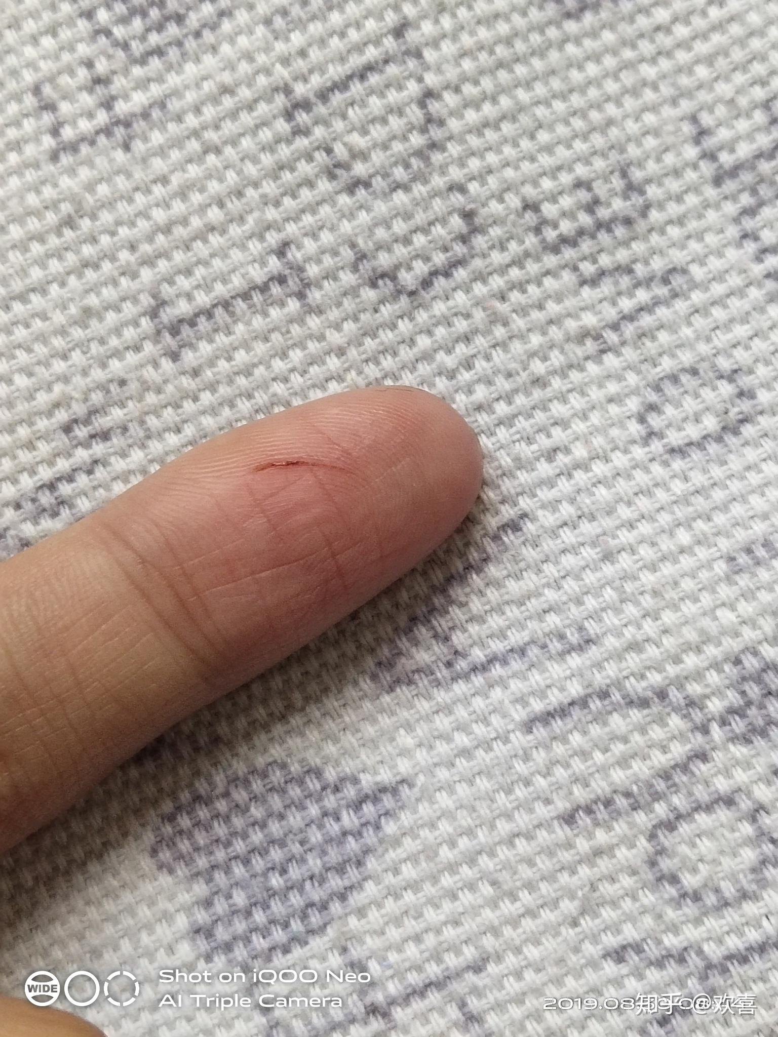 被宠物店的猫咪抓了一下用打疫苗不