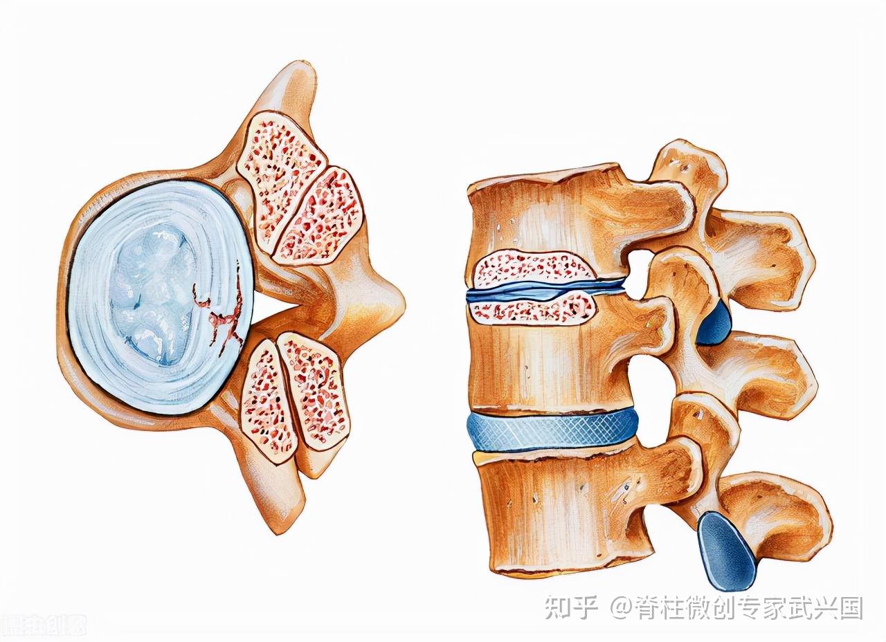 中央管狭窄椎孔是椎骨中心的骨开口,当脊髓沿椎管向下延伸时,保护脊髓