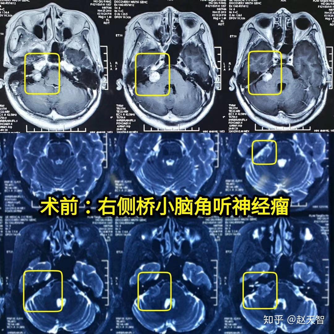 病例分享聽神經瘤微創手術蛛網膜外切除腫瘤完美保留面神經功能