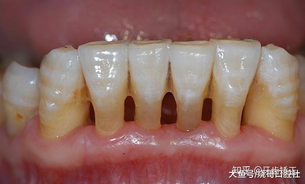 牙齿什么情况下需要做喷砂洗牙?