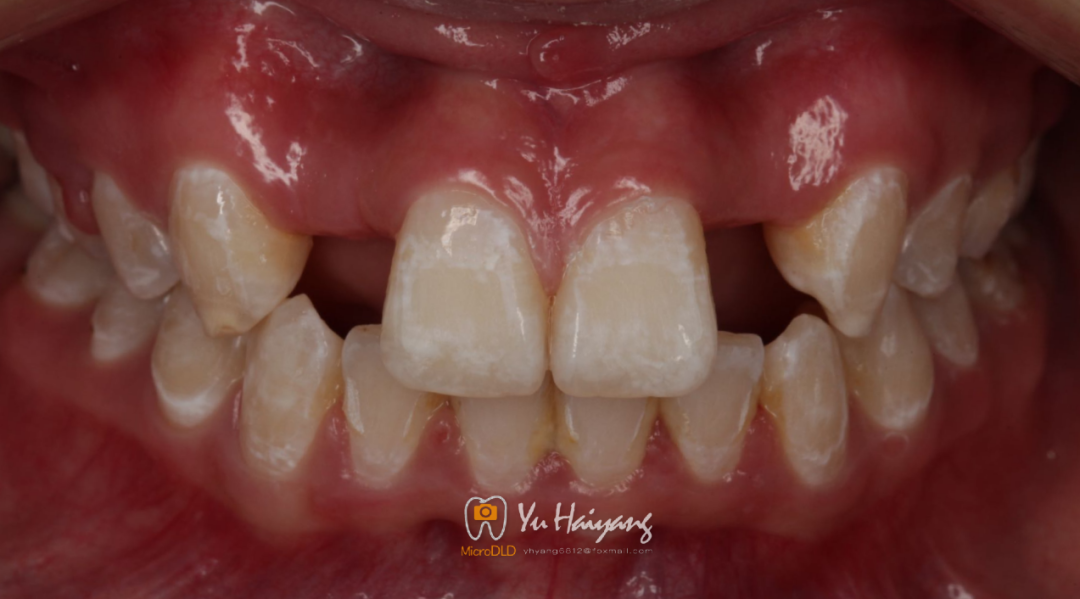 正畸牵引联合氧化锆基台修复双侧侧切牙缺失1例 