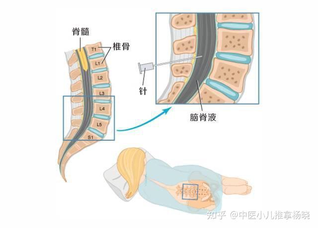 济南中医儿科：为什么给孩子做腰椎穿刺？腰穿危险吗？要注意什么 知乎 