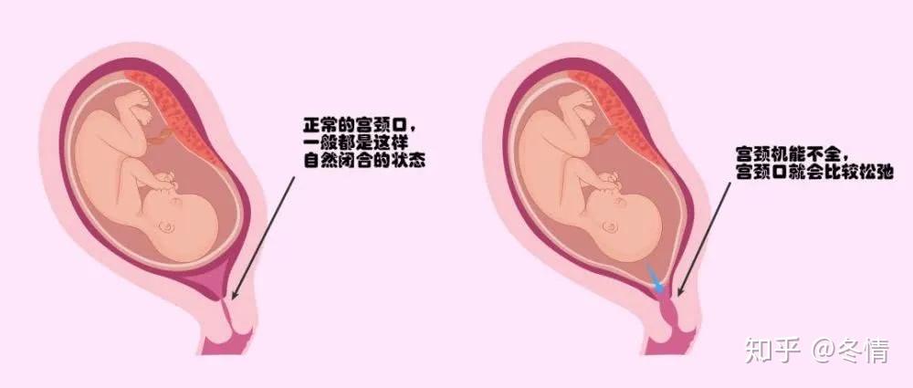 什么是环扎 v2-f4e2a8471d8a4dde14d38a523e3c3c1a_r.jpg
