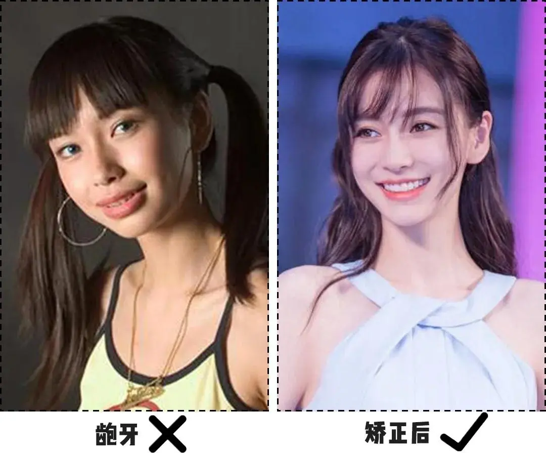 收获一口整齐的牙齿,自信的笑容,还能调整咬合关系,面部结构,改善凸嘴