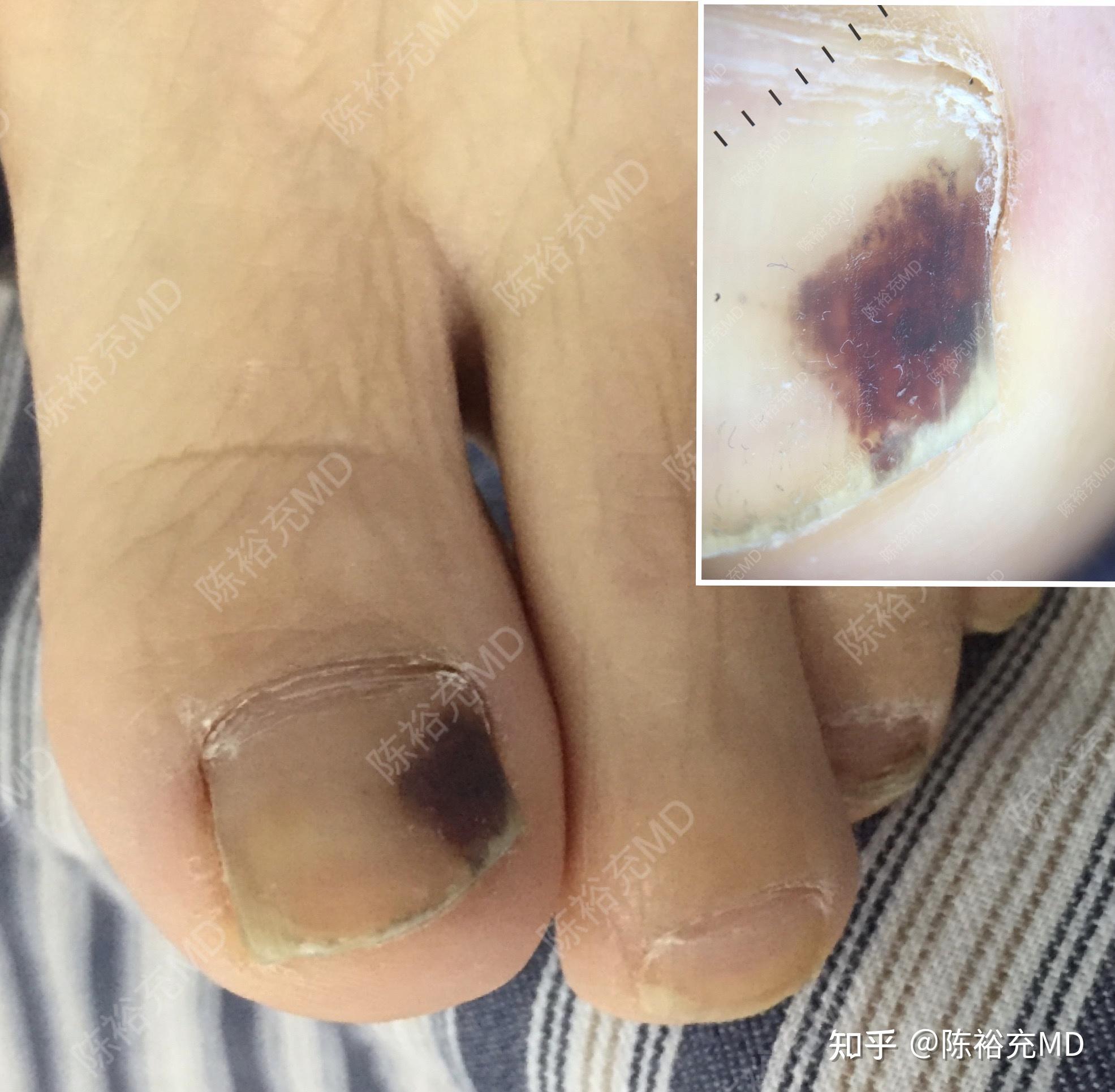 脚指甲黑色素瘤自查图片