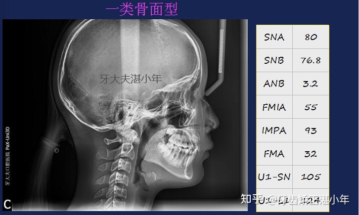 長沙牙齒矯正高難度案例埋伏牙咬合紊亂複雜治療