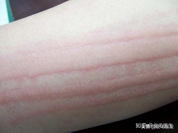 洗澡时一抓就一道道血印,很快又消失,正常吗?严重者会致命