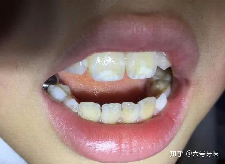 *个别牙齿上出现的白斑(如门牙):牙釉质发育不全(轻度),常出现在切牙