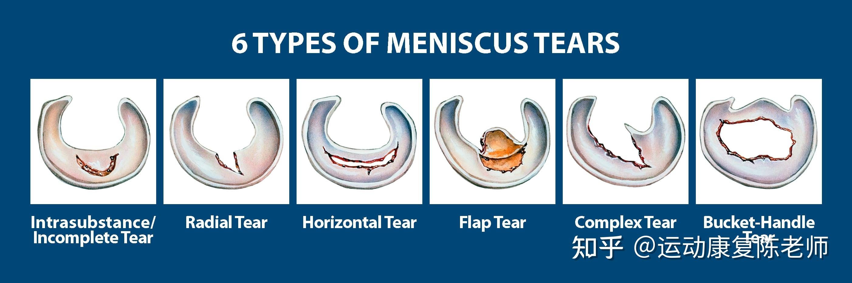 半月板2度损伤之后多长时间才会不痛? 知乎