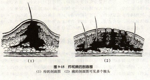 毛囊炎疖痈皮脂腺囊肿怎么区分