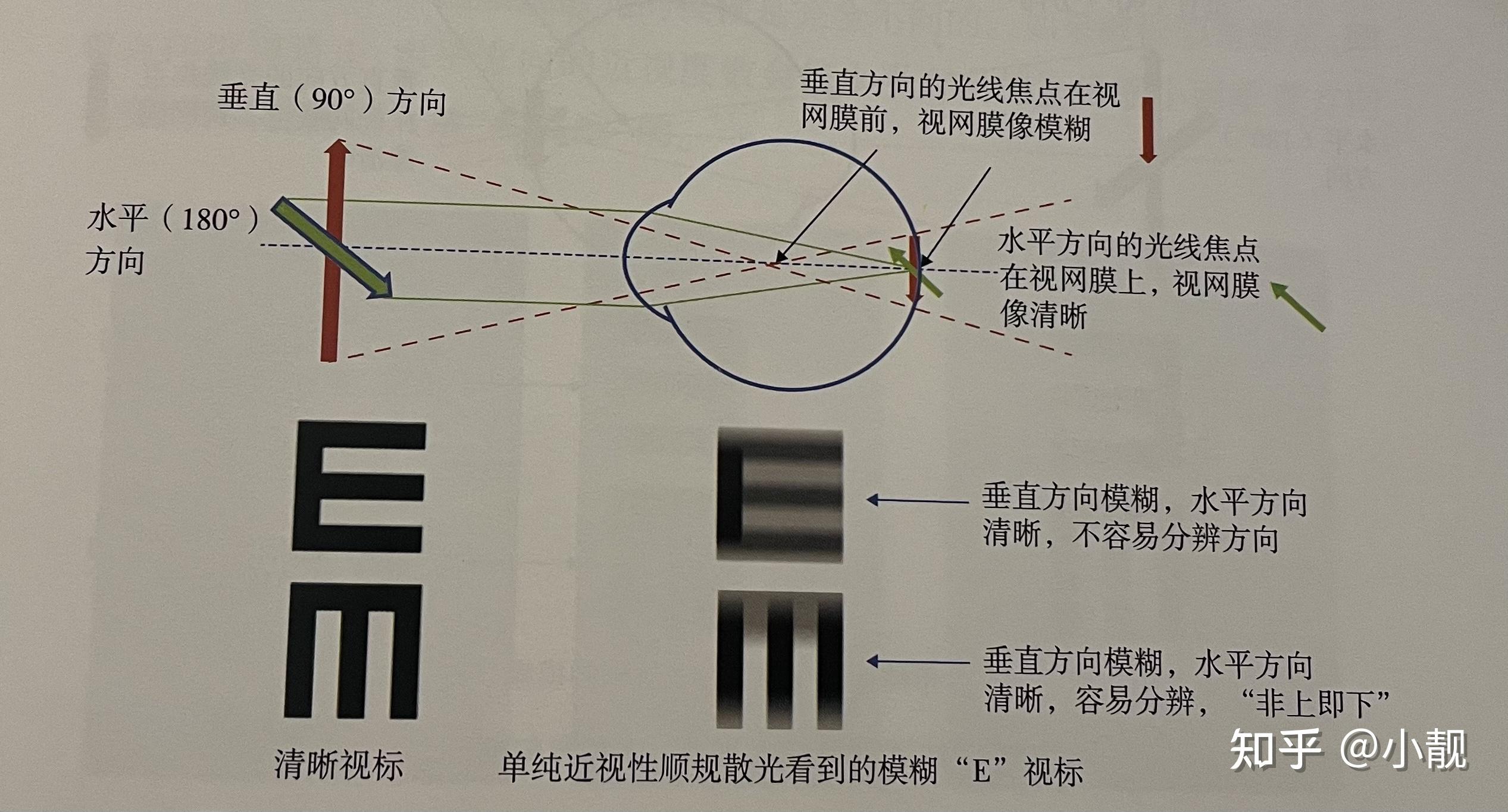 单纯近视性顺规散光l:200dcx180r: