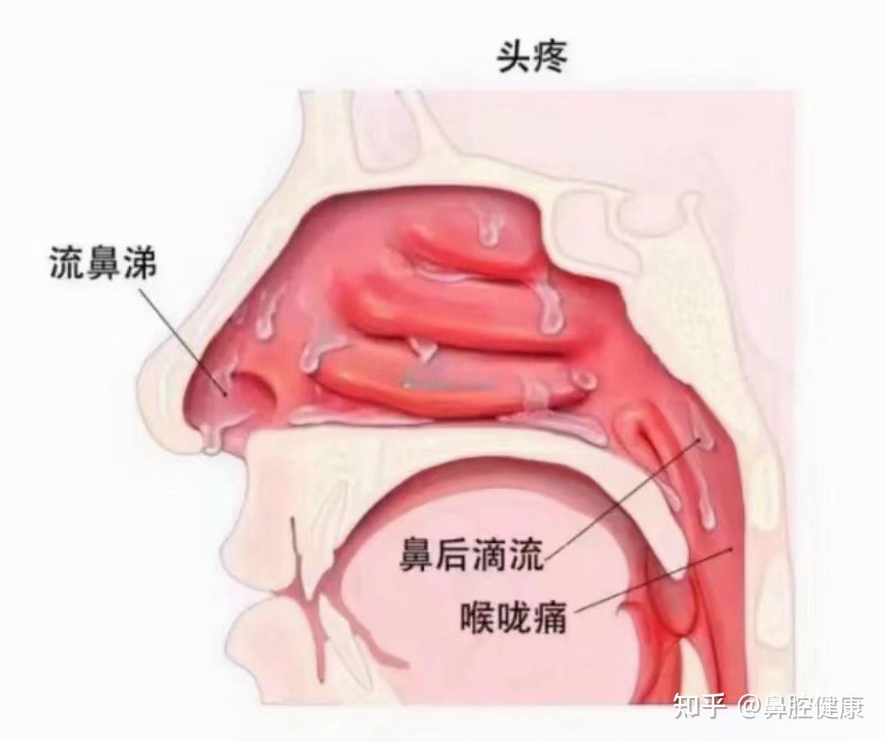 慢性鼻炎能否自愈图片