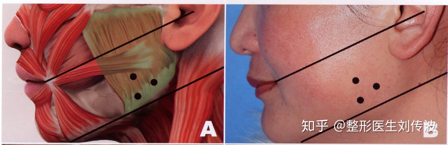 咬肌注射点位置图图片