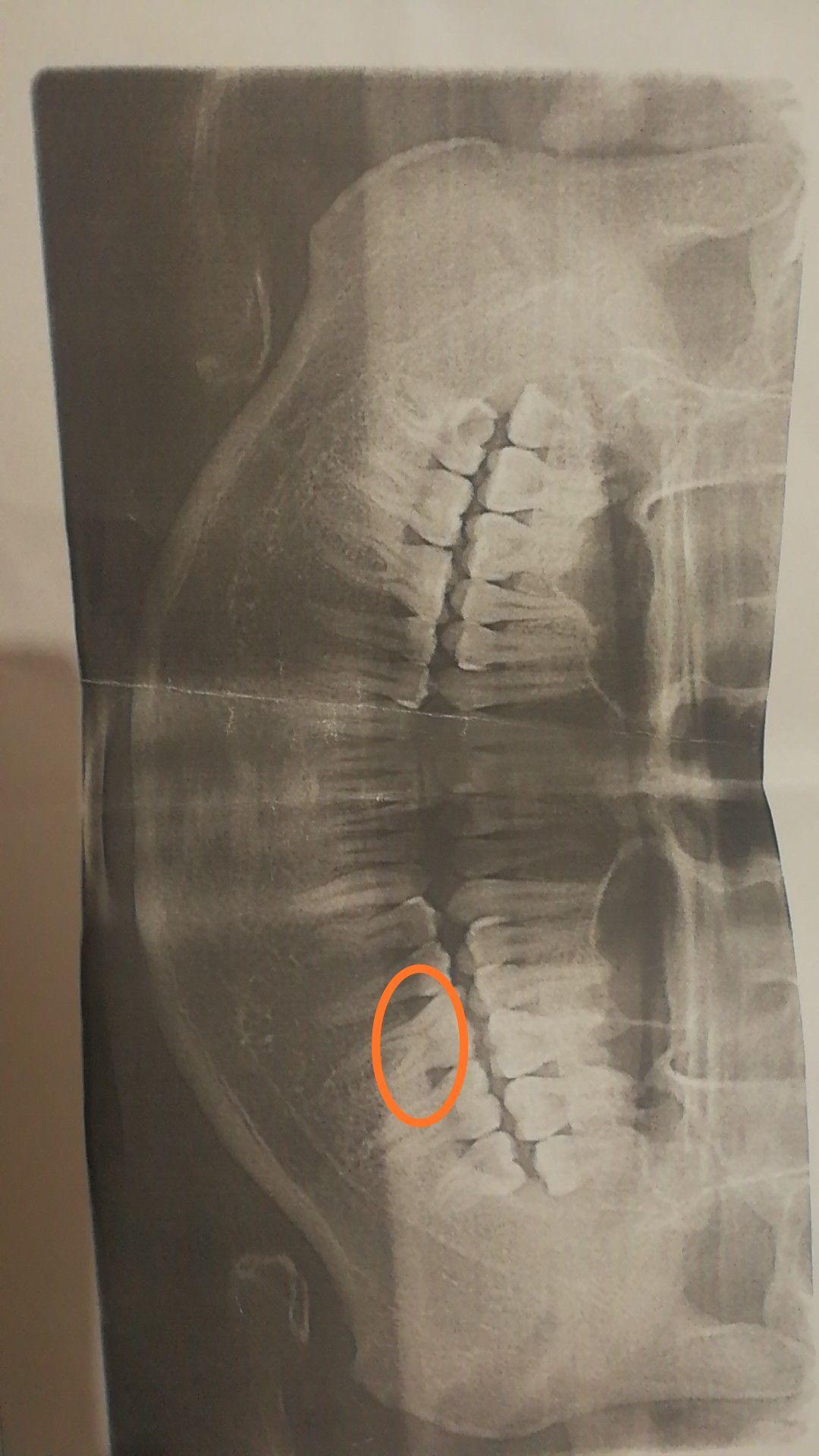 求教这个牙片能看出有牙龈萎缩症状吗?