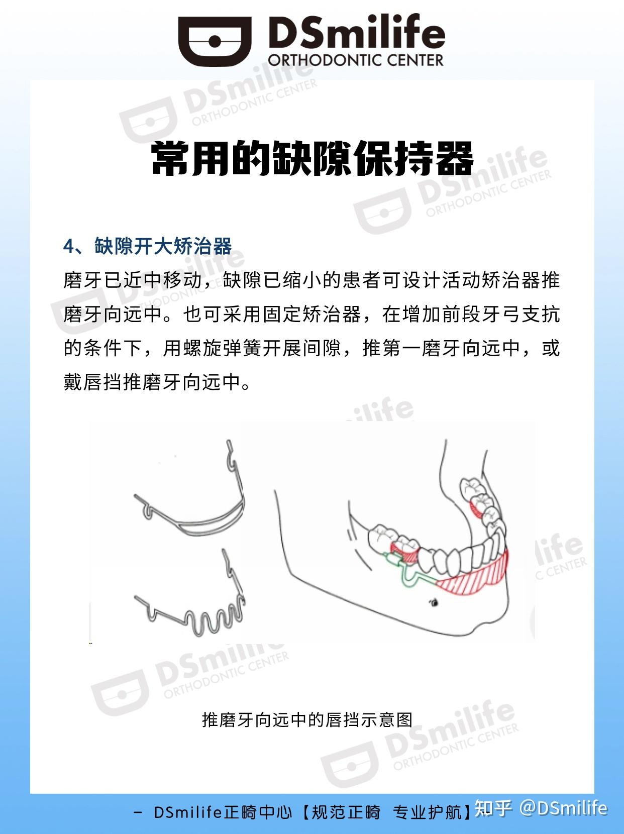 间隙保持器图片 危害图片