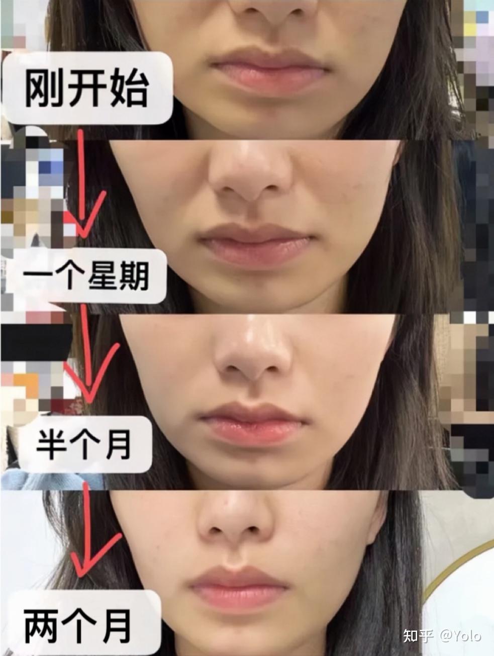 【皮肤科医生】从专业角度看,消除法令纹最快最有效的方法是什么? - 知乎