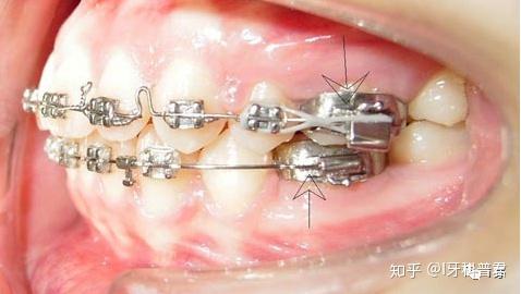 你正畸时最后一颗牙上是什么带环or颊管