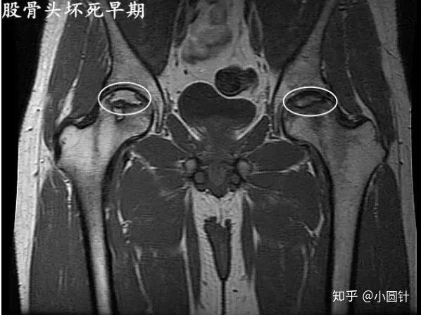 股骨头坏死MRI图片