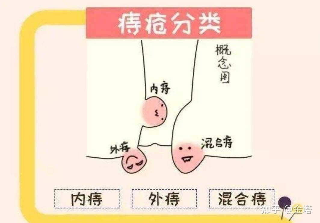 轻微痔疮能自愈吗图片