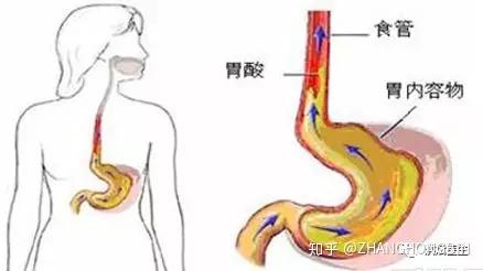 经常感觉胸口难受 可能是反流性食管炎搞的鬼 知乎