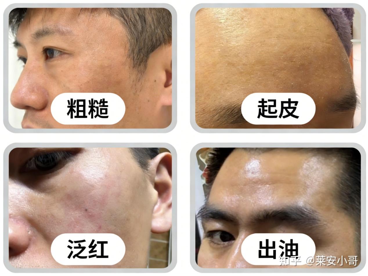 2026震撼首发！男生护肤别硬扛【出油、长痘、起皮、泛红】一网打尽！这可能是全网最简单小白的【男士水乳】选择指南！