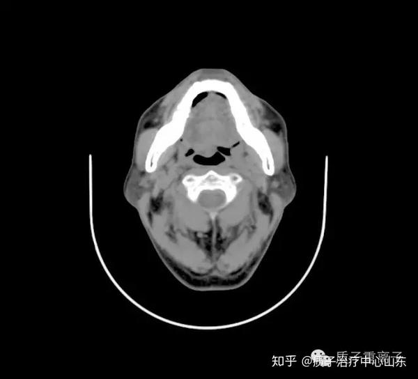 舌根癌质子治疗本院病例分享