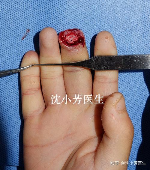 请看病例:儿童手指末节经常受外伤缺损,若可以第一时间进行断指再植是