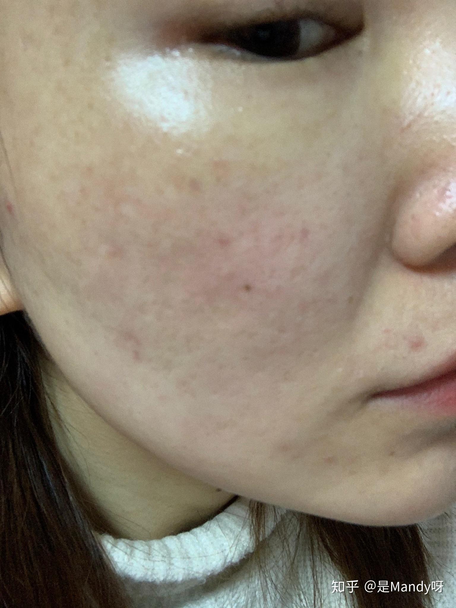 皮肤修复过程痒怎么办 v2-f5c6d352e534b254fcebb9436bac1afe_r.jpg