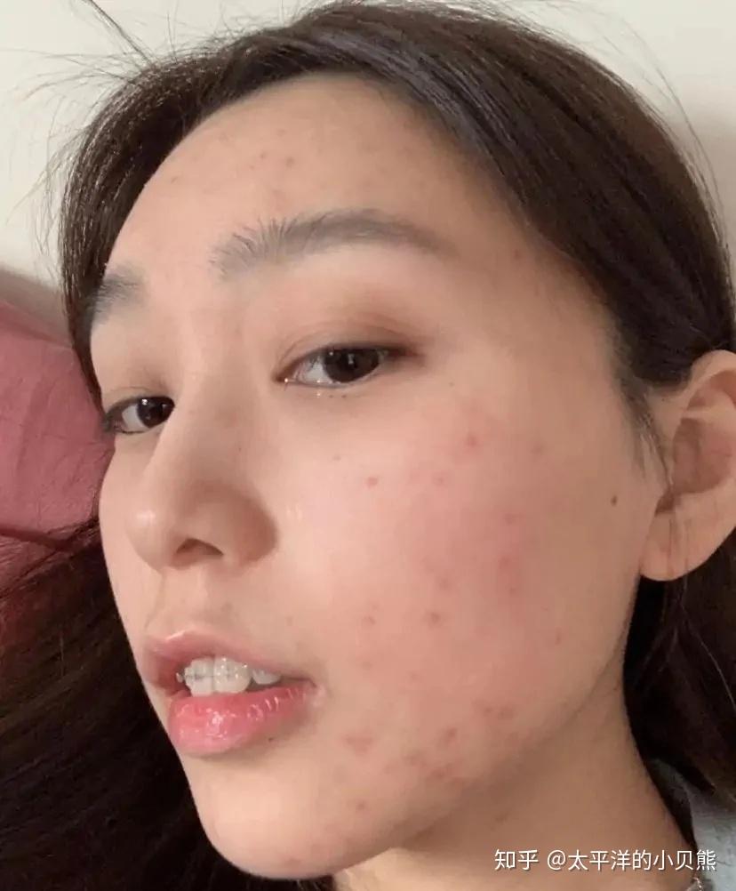 痘痘痘印一脸都是都不敢谈恋爱这样可以祛除痘痘