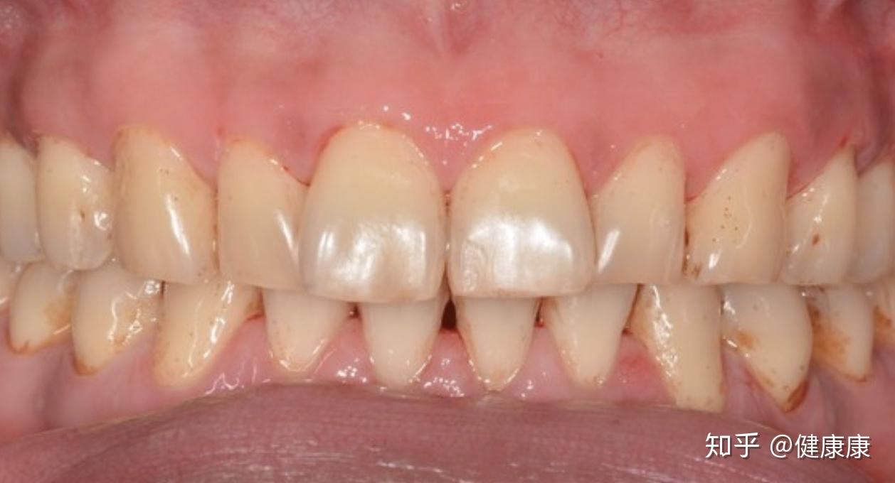 美白粉别乱涂医解析牙齿泛黄发黑3大原因抽烟其实最易解
