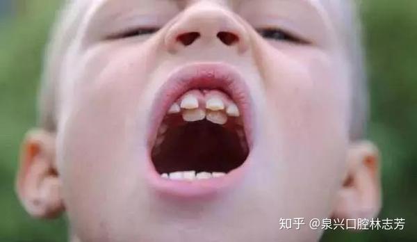 孩子出现多生牙怎么办 家长别慌 知乎