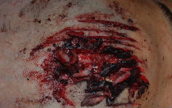 机械性损伤之锐器伤讲讲自伤的刀法差异