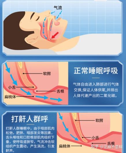 凌晨时分被枕边人打鼾吵到无心睡眠是有多难,不妨送他nitetronic添眠智能止鼾枕