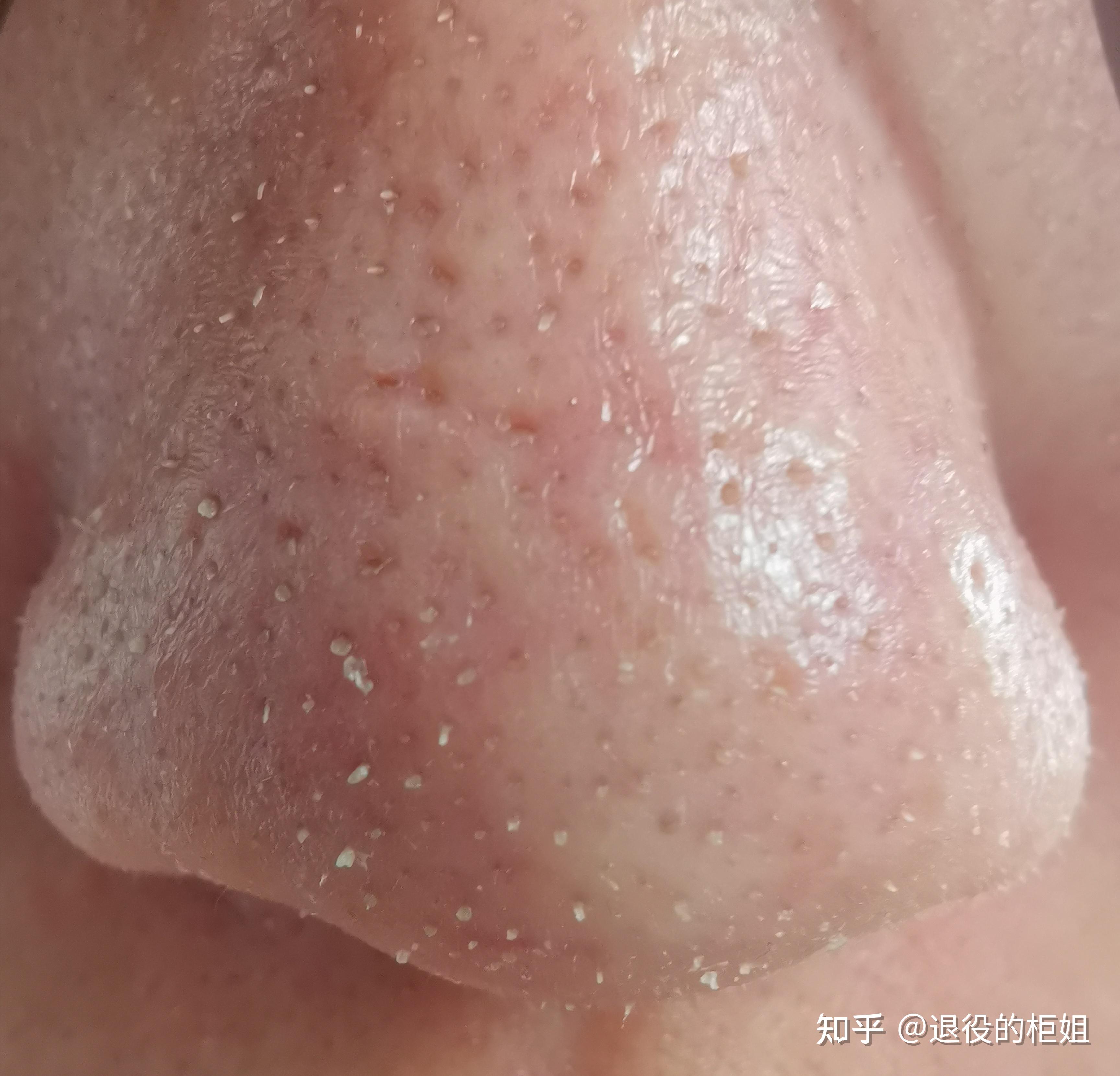 美容院的韩国超微小气泡是什么去黑头效果好吗自己可以在家里做吗