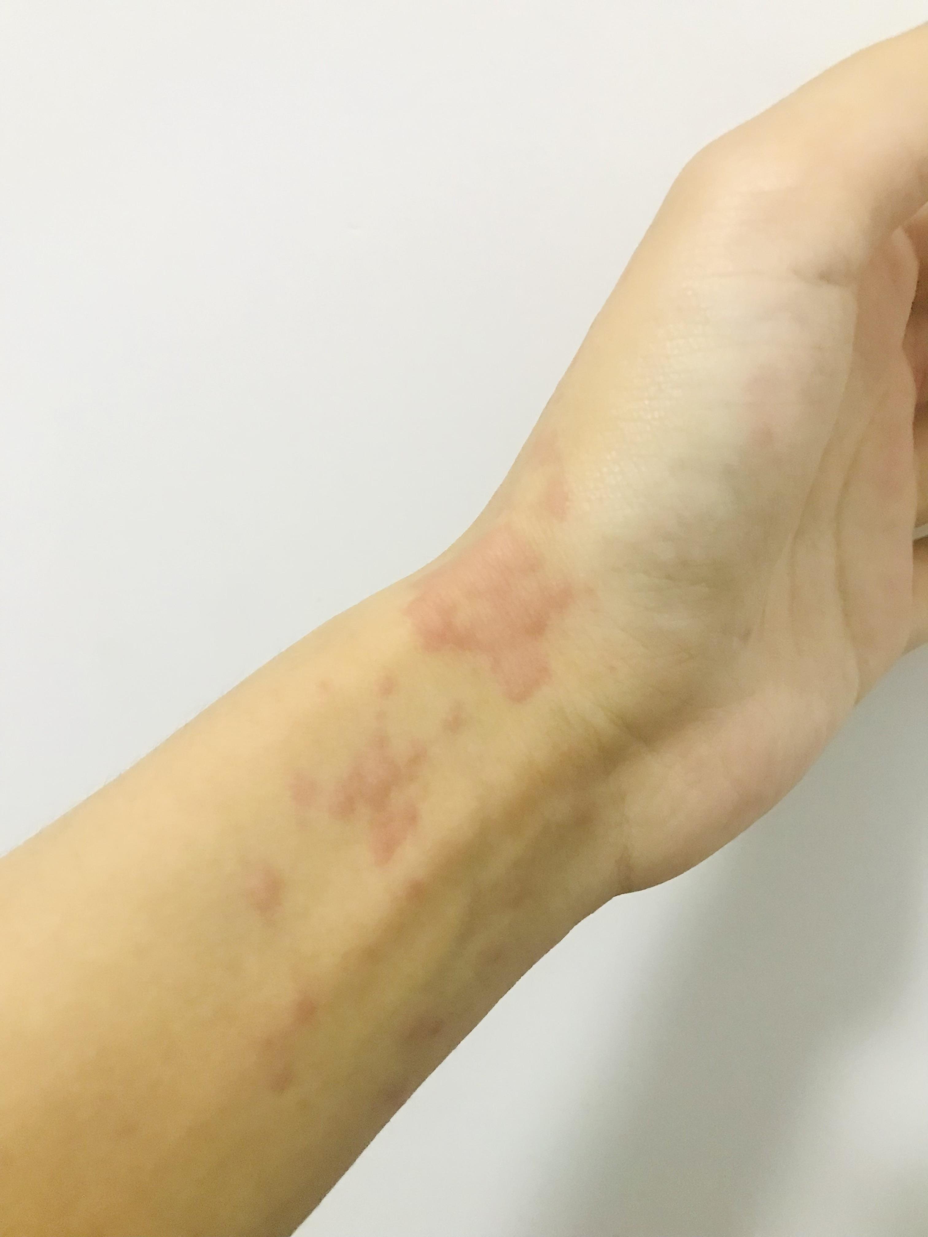 记录我的过敏荨麻疹经历