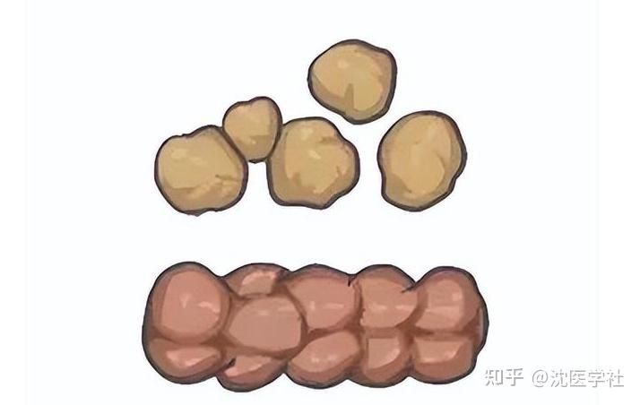 便秘?大便干硬,像羊粪?一个六味地黄丸,帮你排空黑硬便 - 知乎