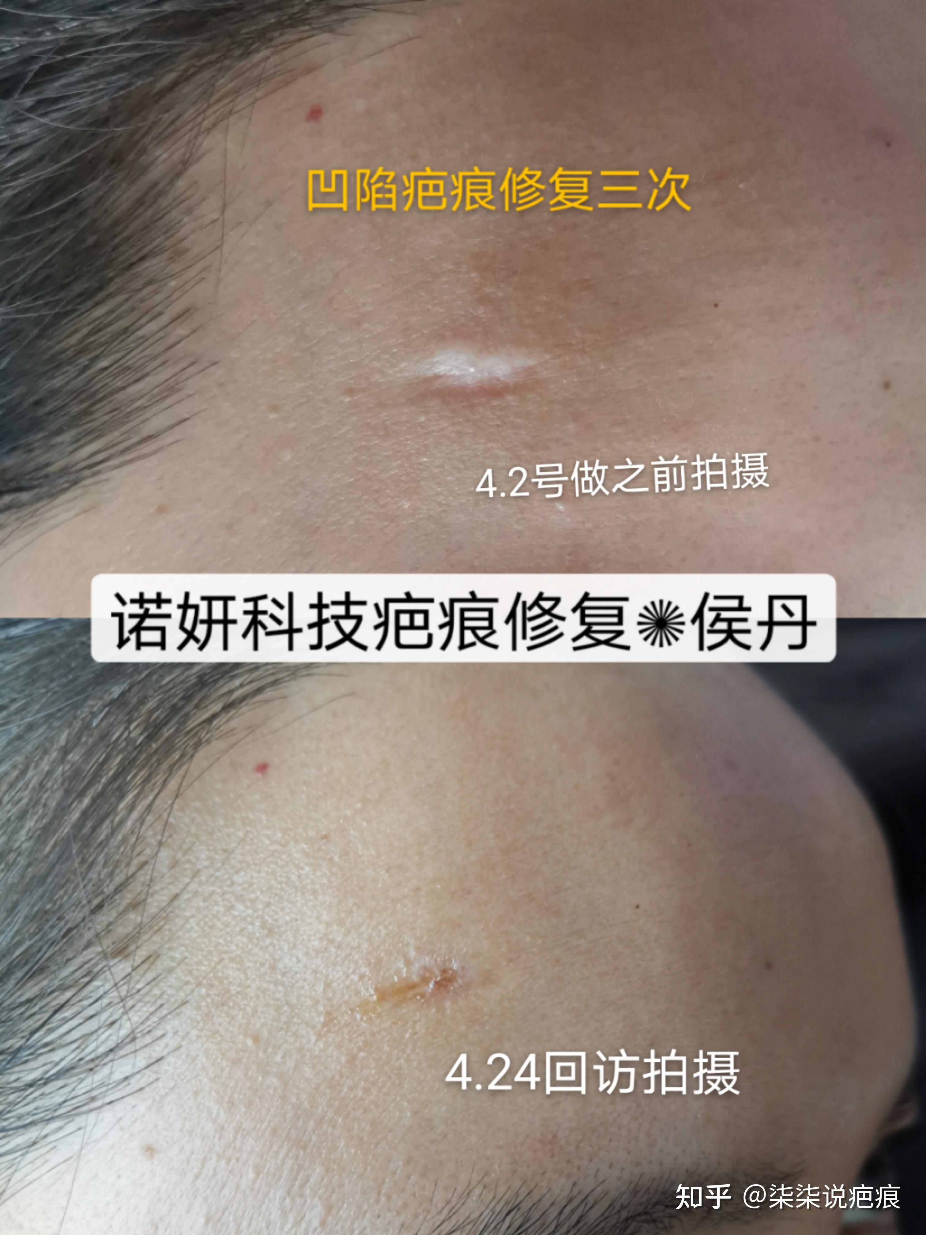 α姐姐说疤痕-凹陷疤痕修复