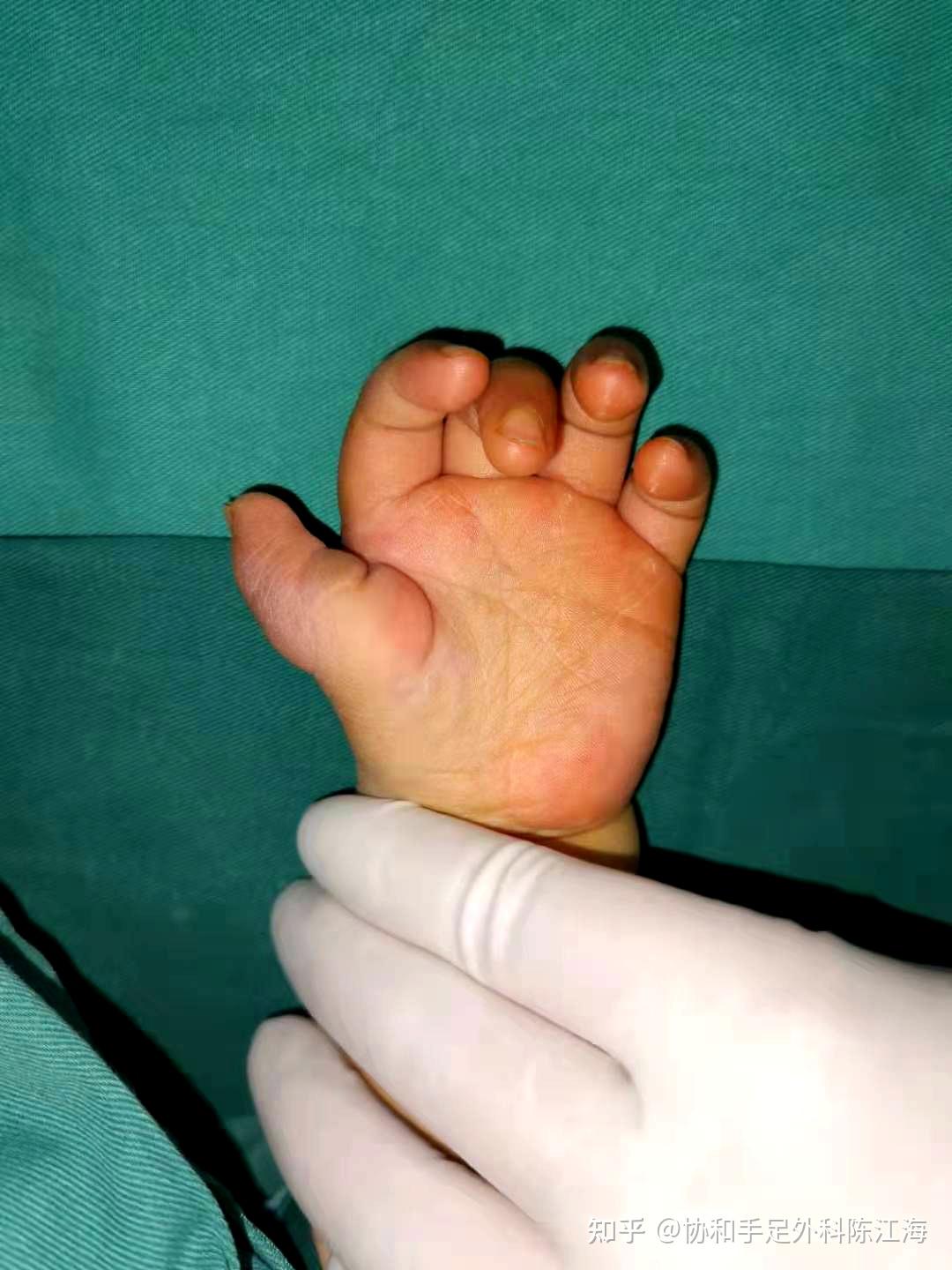 宝宝第一掌骨发育不全悬浮指怎么办可以不做示指拇化保下来吗