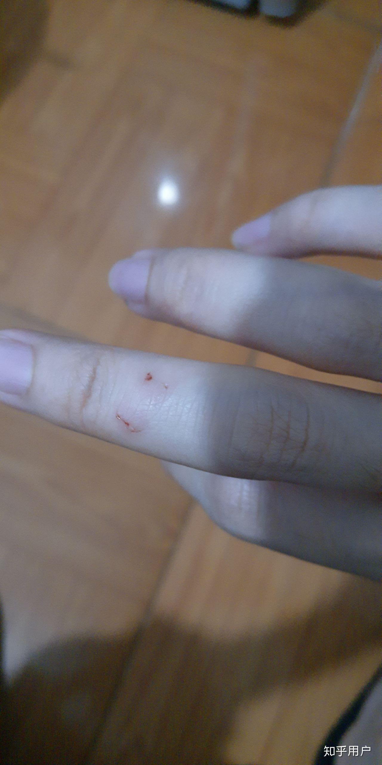 被宠物兔咬了有没有必要注射狂犬疫苗