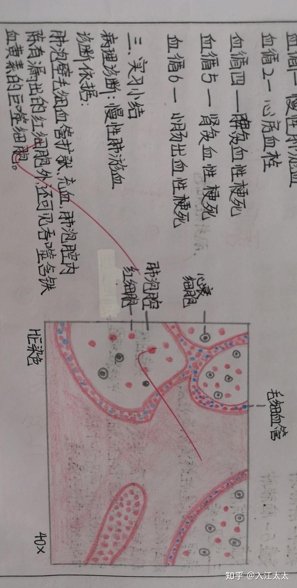 慢性肺淤血急性蜂窝织炎性阑尾鳞状细胞癌风湿性心内膜炎胃消化性胃
