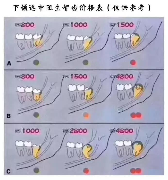 一個蘿蔔一個坑,一個智齒一個位點.