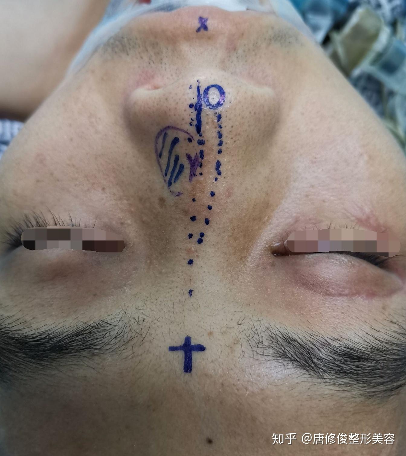 鼻骨复位手术过程图解图片