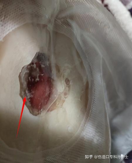 造口处有很多粘液?