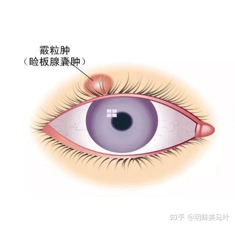 睑板腺囊肿详解：成因、治疗方法及预防策略 - 知乎