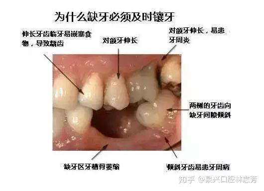 牙齿缺失不补有哪些危害 知乎