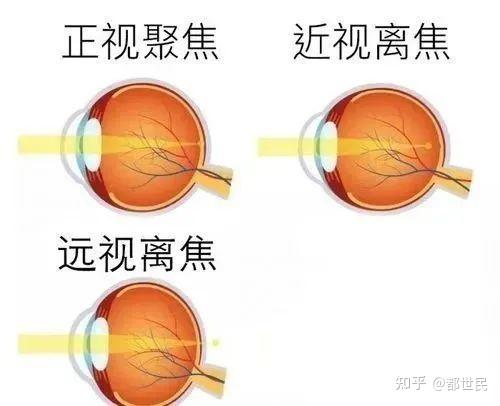 “离焦”概念能治好近视眼吗? ——-现代视觉的新问题〔7〕 - 知乎